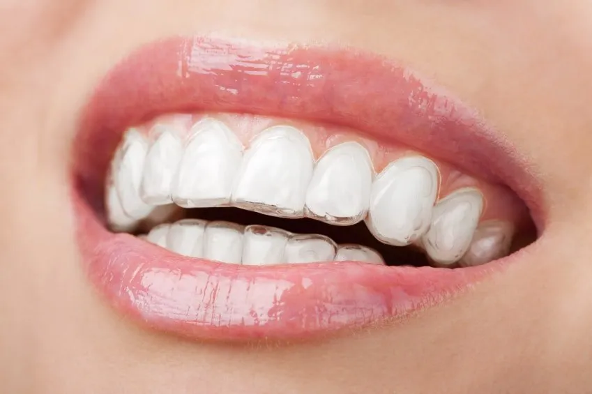 Braces & Aligners