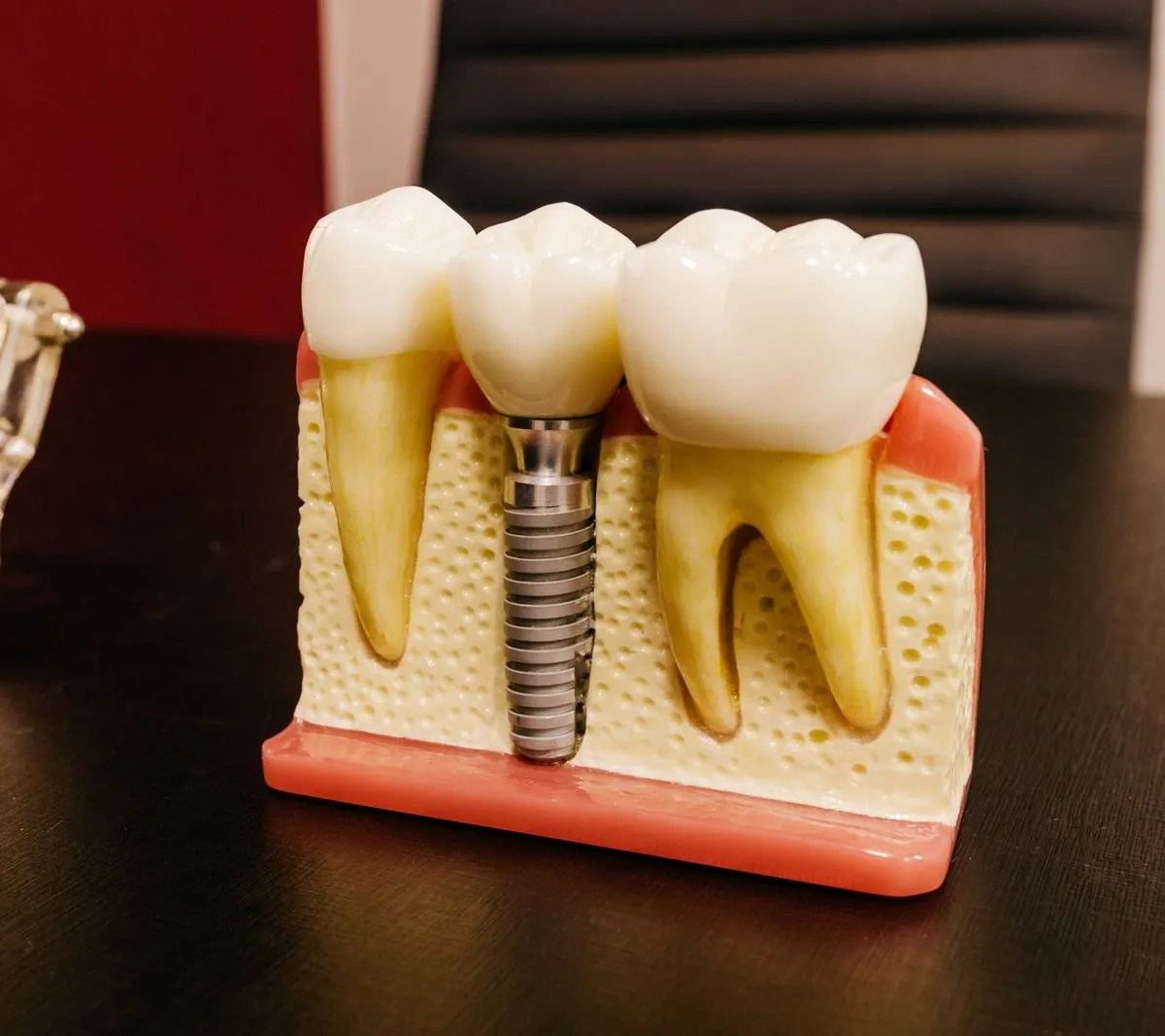 What should I know before Dental Implants?